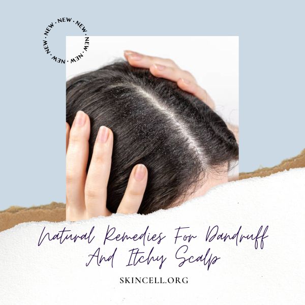 Natural Remedies For Dandruff And Itchy Scalp