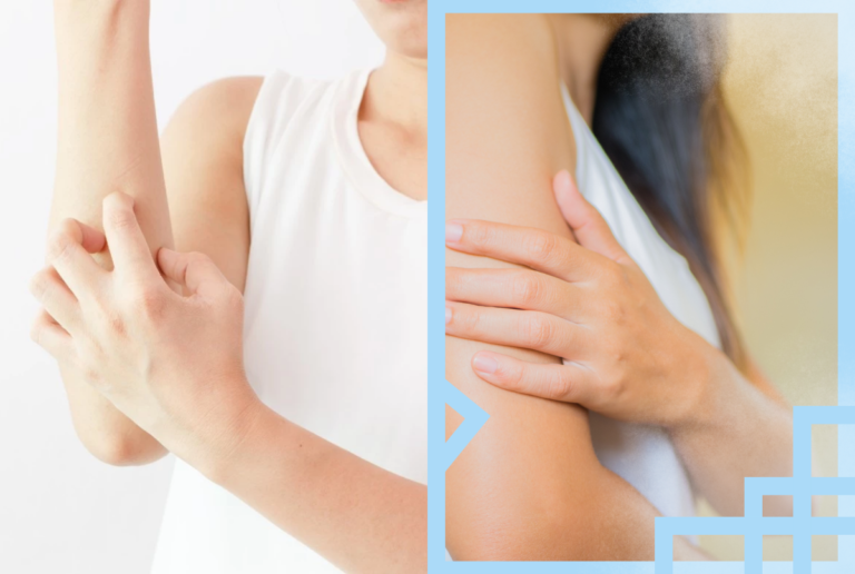 What Causes Eczema In Adults?
