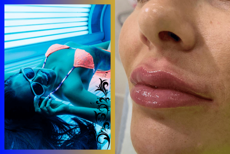Do Tanning Beds Dissolve Lip Fillers?